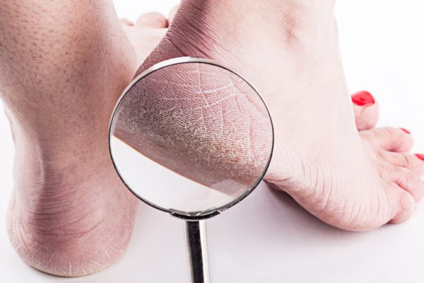 5 Cara Merawat Kaki agar Terhindar dari Tumit Pecah-Pecah