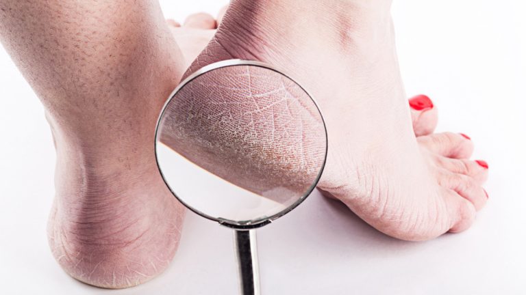 5 Cara Merawat Kaki agar Terhindar dari Tumit Pecah-Pecah