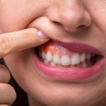 5 Tanda Gusi Kamu Sedang Tidak Sehat