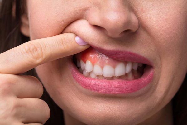 5 Tanda Gusi Kamu Sedang Tidak Sehat