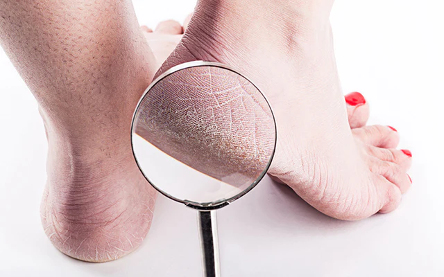 5 Cara Merawat Kaki Agar Terhindar dari Tumit Pecah-Pecah
