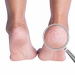 5 Cara Merawat Kaki agar Terhindar dari Tumit Pecah-Pecah