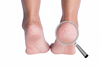 5 Cara Merawat Kaki agar Terhindar dari Tumit Pecah-Pecah