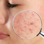 10 Kebiasaan Sehari-hari yang Bikin Jerawat Makin Parah