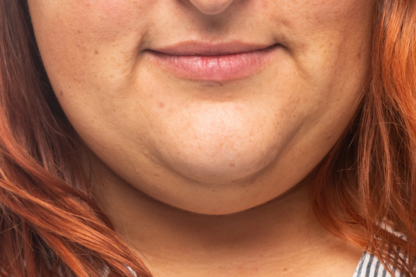 10 Cara Menghilangkan Double Chin secara Alami