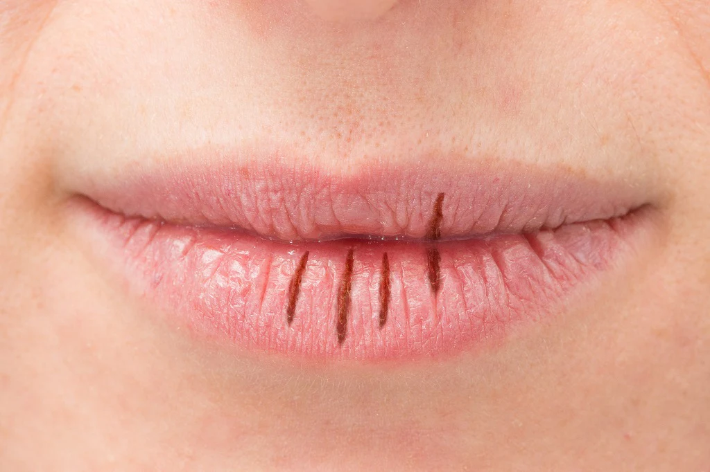 5 Cara Mengatasi Bibir Pecah-Pecah Tanpa Lip Balm