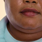 10 Cara Menghilangkan Double Chin Tanpa Gym