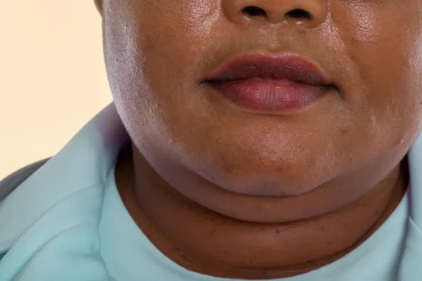 10 Cara Menghilangkan Double Chin Tanpa Gym