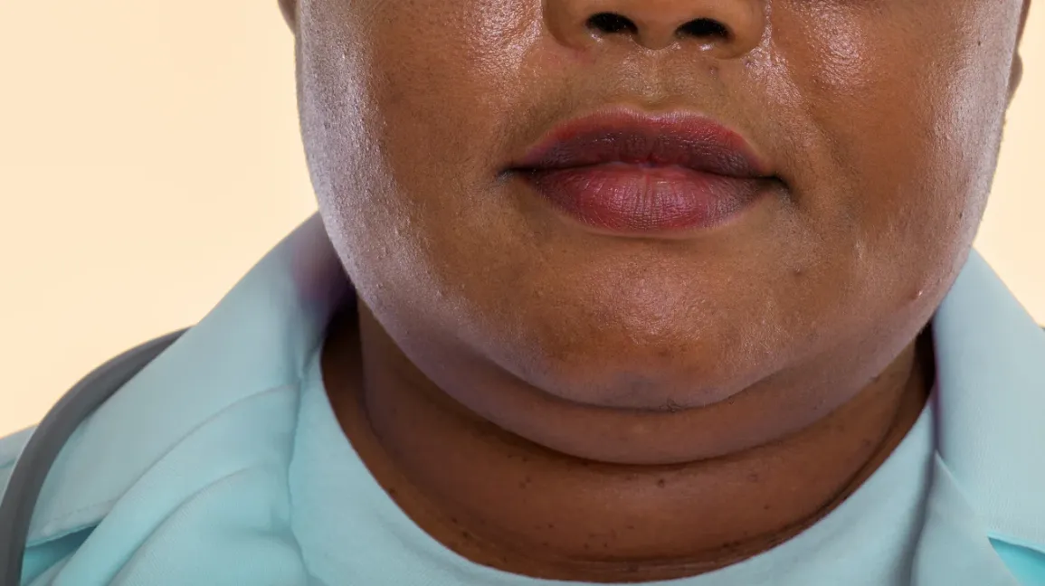 10 Cara Menghilangkan Double Chin Tanpa Gym