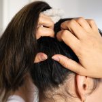 5 Cara Mengatasi Kulit Kepala Kering dan Gatal
